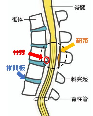 脊柱管狭窄症　骨棘　靭帯　椎間板のイラスト